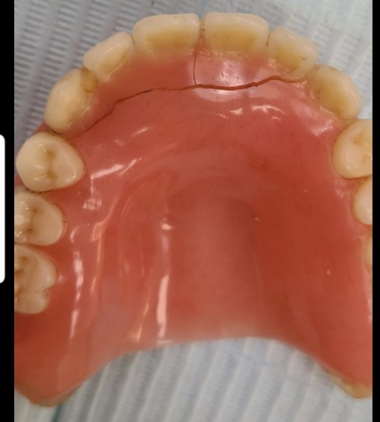 Denture Reline or Rebase